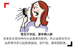 武汉专治疗脱发医院_分析脱发的原因以及