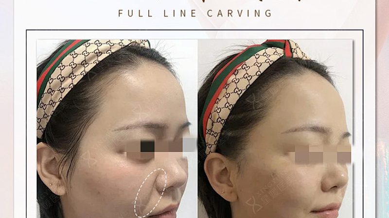 尽管市面上有水光针DIY套装，但考虑到以下因素，我们不建议在家进行水光针保养：