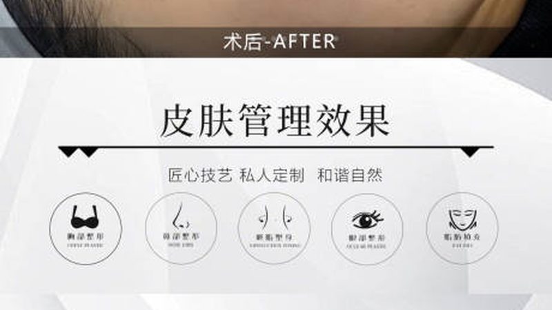 玻尿酸水光针OEM代理：揭秘其背后的技术与应用