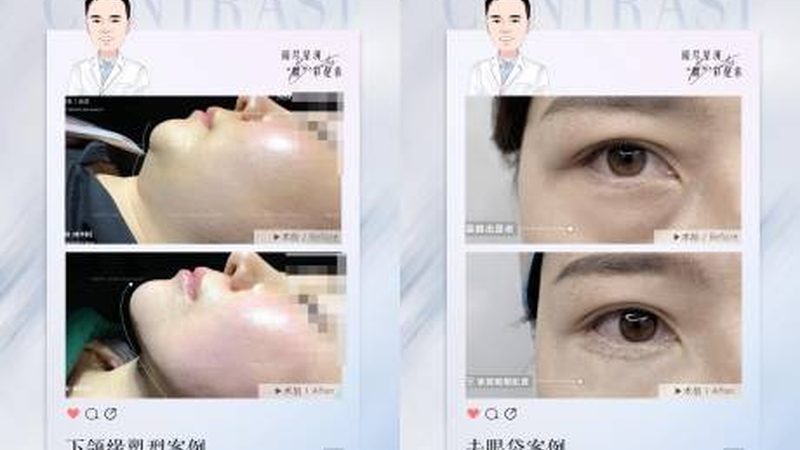热玛吉，如何实现面部提升的魔法效果？**