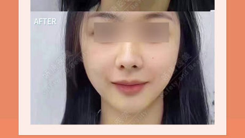 鼻部手术局麻与全麻：哪种更适合你？**