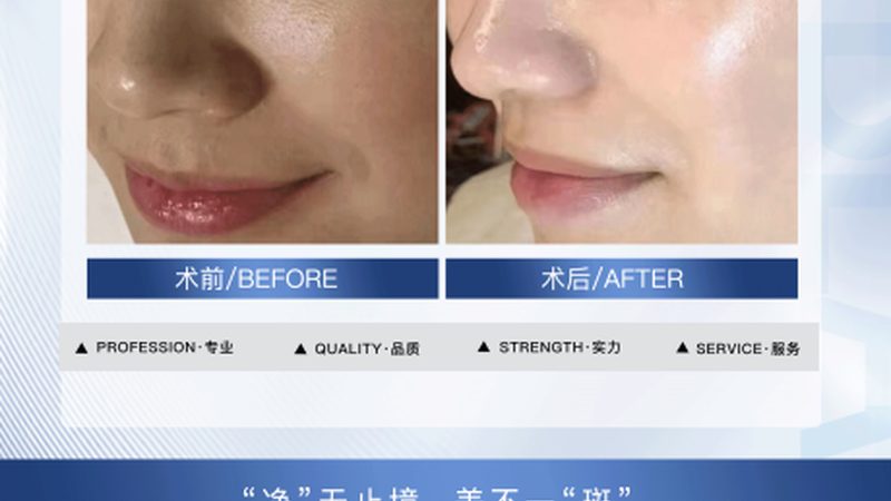 热玛吉效果能维持多久？揭秘其持久秘密