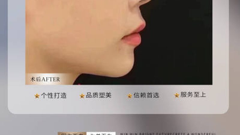 隆鼻失败？二次手术，这些注意事项要知道**