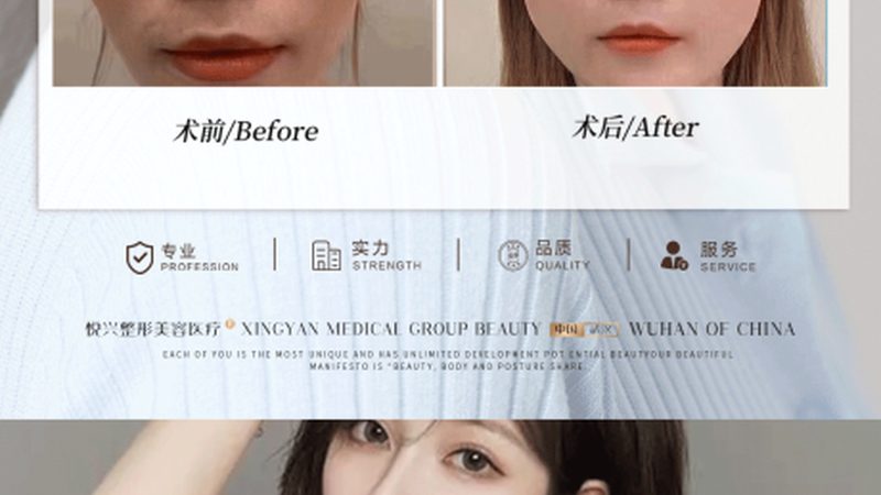 打完玻尿酸别急着美，恢复期做对这几件事才不白花钱