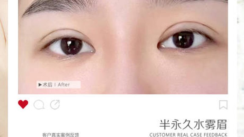 选择双眼皮手术方法时，应考虑以下因素：