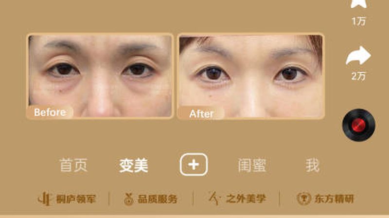 热玛吉，揭秘非手术紧肤的奥秘